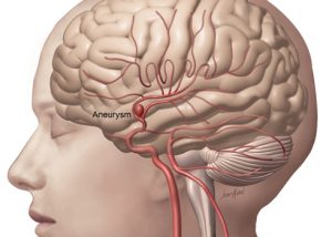 aneurysm-2 Neurosurgeon in Aurangabad