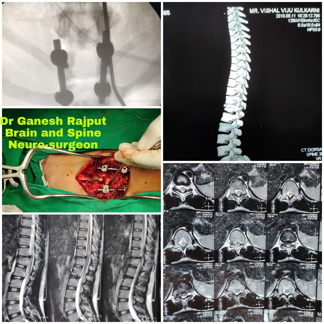 IMG-20200303-WA0073 Endoscopic Spine Surgery in Parbhani